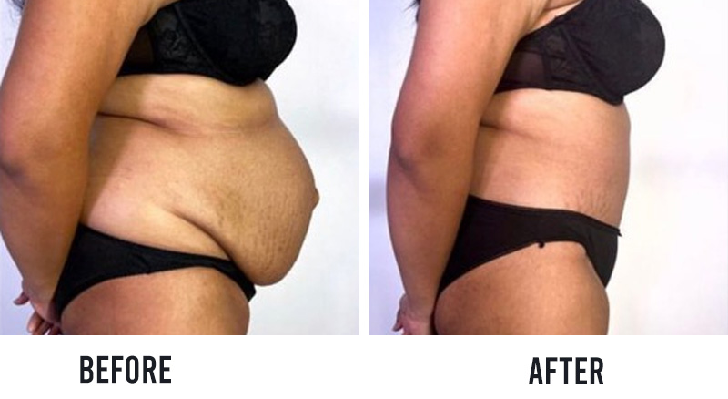 before and after tummy tuck surgery